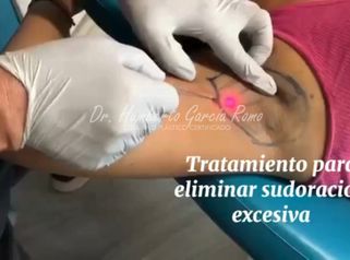 Hiperhidrosis Axilar - Dr. Jorge Humberto García Romo