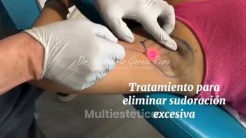 Hiperhidrosis Axilar - Dr. Jorge Humberto García Romo