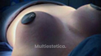Aumento de busto - Eleganza by Dr. Francisco Rodriguez