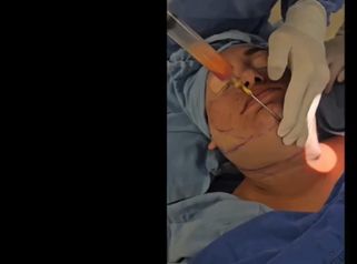 Lipopapada Con Bichectomia -Dr. Carlos Woge
