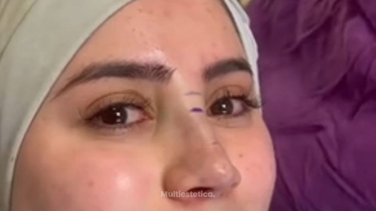 Rinoplastia - Dr. Alejandro Méndez Sashida