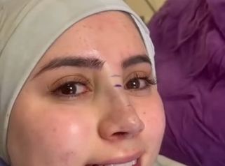 Rinoplastia - Dr. Alejandro Méndez Sashida