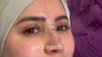 Rinoplastia - Dr. Alejandro Méndez Sashida