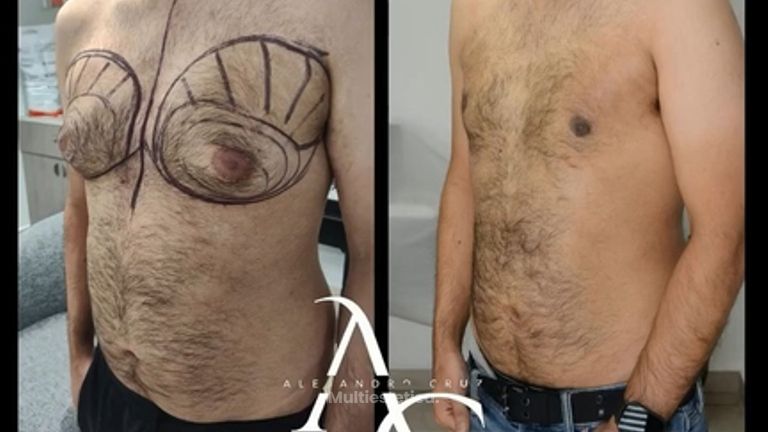 Cirugia Ginecomastia - Dr. Alejandro Cruz Segura