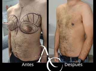 Cirugia Ginecomastia - Dr. Alejandro Cruz Segura