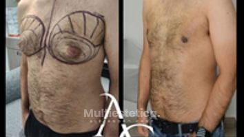 Cirugia Ginecomastia - Dr. Alejandro Cruz Segura
