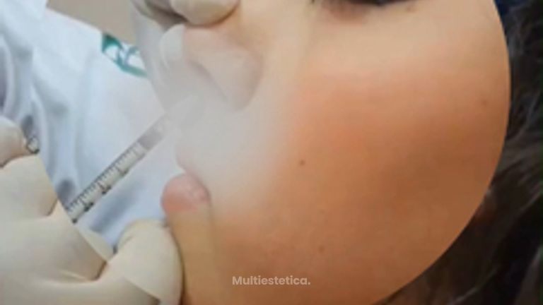 Rinomodelación - Dr. Andrés Raúl Cortés Ponce