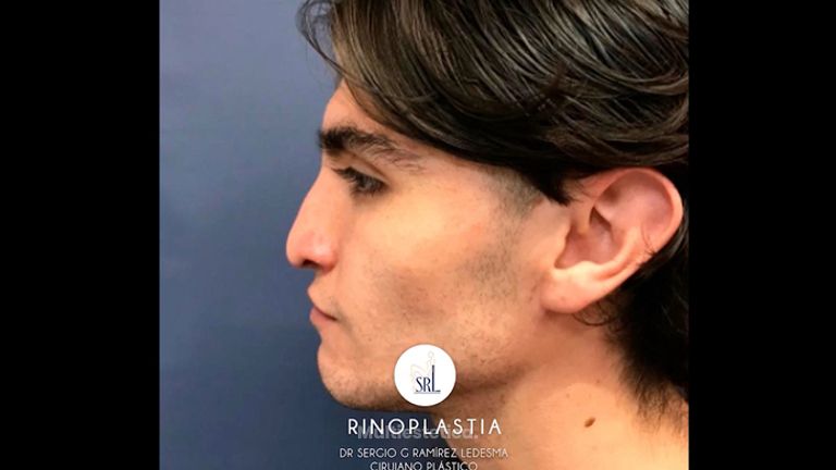 Rinoplastia - Dr. Sergio Guillermo Ramírez Ledesma