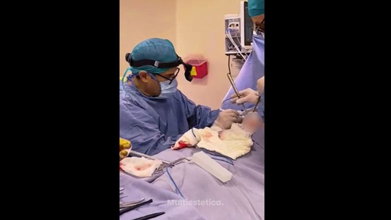Aumento de busto - Dr. Xavier Sánchez García