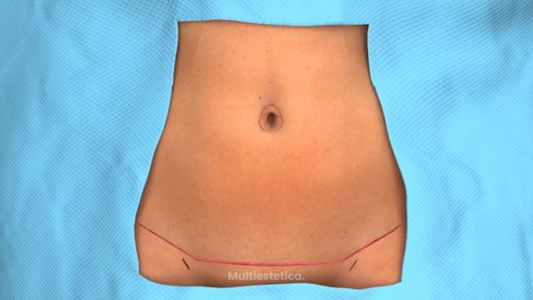Abdominoplastia