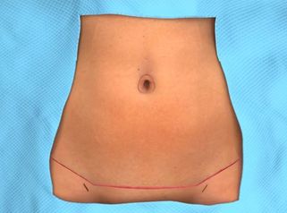 Abdominoplastia