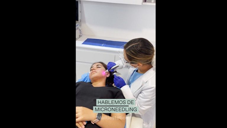 Microneedling - Merlos & Caraza