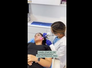 Microneedling - Merlos & Caraza