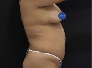 Lipoescultura - Dr. Lenin Alfonso Reyes Ibarra