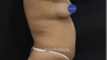 Lipoescultura - Dr. Lenin Alfonso Reyes Ibarra