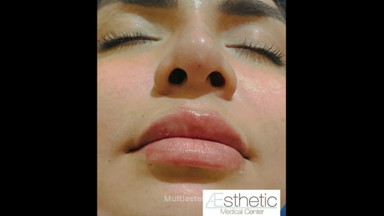 Aumento de labios - Dr. Sinué Orihuela García