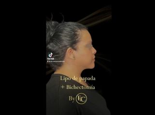 Bichectomía + Lipopapada - Dr. Franco Cravioto