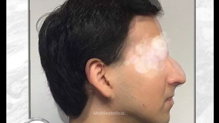 Rinoplastia