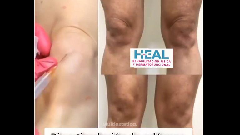 Bioestimulador de colágeno - Clínica Heal Aesthetics
