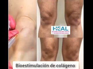 Bioestimulador de colágeno - Clínica Heal Aesthetics