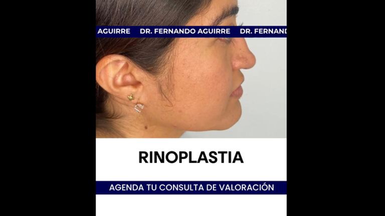 Rinoplastia - Dr. Carlos Fernando Aguirre Muñoz