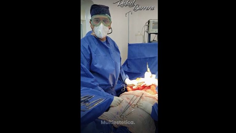 Abdominoplastia - Dr. Rafael Barrera Vazquez