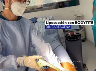 Liposucción - Dr. Eduardo Cartagena