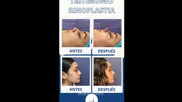 Rinoplastia - Dr Sergio Guillermo Ramírez Ledesma