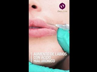 Aumento de labios con Ácido Hialurónico