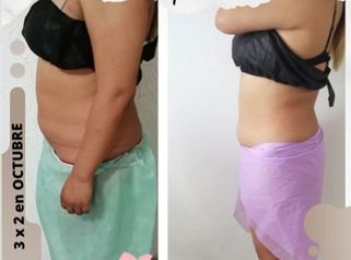 Hidrolipoclasia - Dra. Yesenia Figueroa Velasco