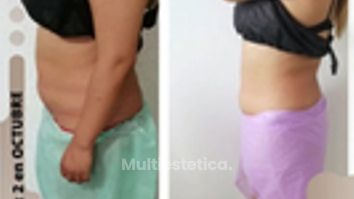 Hidrolipoclasia - Dra. Yesenia Figueroa Velasco