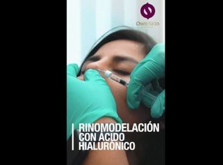 Rinomodelación con Ácido Hialurónico