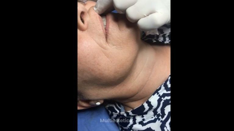 Rellenos ácido hialurónico sin inyecciones y sin dolor