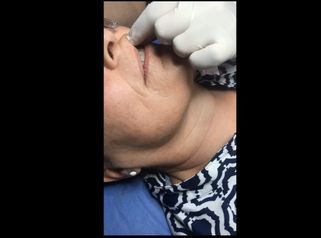 Rellenos ácido hialurónico sin inyecciones y sin dolor