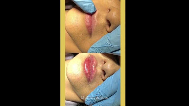 Aumento de labios