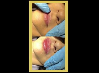 Aumento de labios
