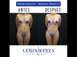 Abdominoplastia - Dr. Lenin Alfonso Reyes Ibarra
