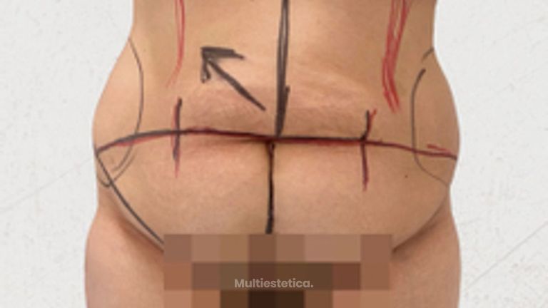 Abdominoplastia - Dra. Maria Antonia Hernández Sepúlveda