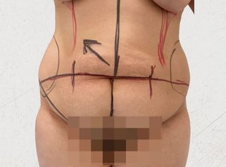 Abdominoplastia - Dra. Maria Antonia Hernández Sepúlveda