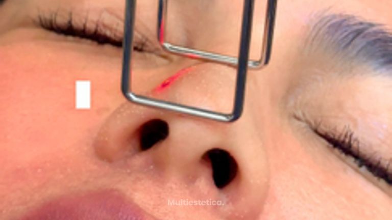 Rejuvenecimiento Facial - Dr. Irvin J Cervantes