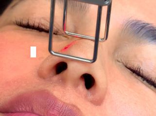 Rejuvenecimiento Facial - Dr. Irvin J Cervantes