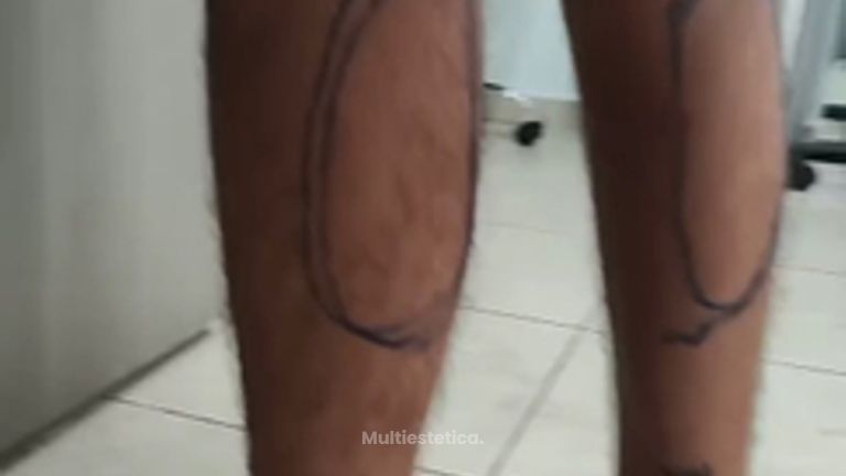 Aumento de Pantorrillas - Dr. Alejandro Cruz Segura