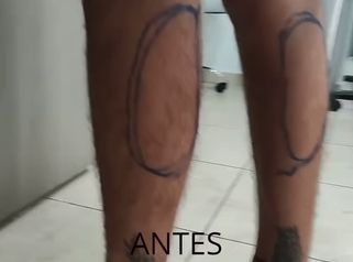 Aumento de Pantorrillas - Dr. Alejandro Cruz Segura