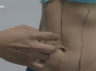 Lipoescultura