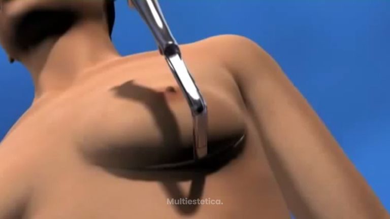 Luce un pecho más bonito