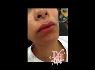 Aumento de labios - Dra. Diana Hannah Carreón
