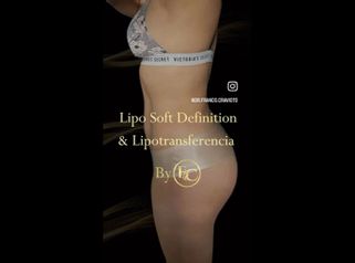 Liposucción - Dr. Franco Cravioto
