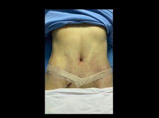 Abdominoplastia - Dra. Maria Antonia Hernández Sepúlveda