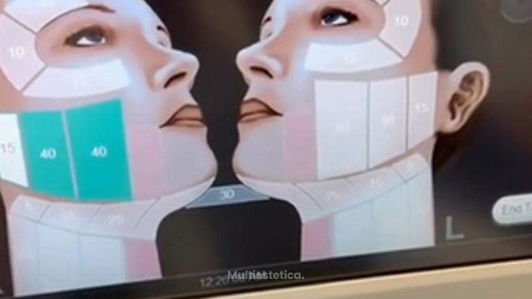 Ultherapy Lifting Sin Cirugia -Dr. Alejandro Méndez Sashida