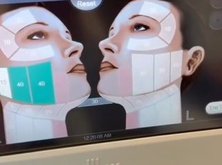 Ultherapy Lifting Sin Cirugia -Dr. Alejandro Méndez Sashida